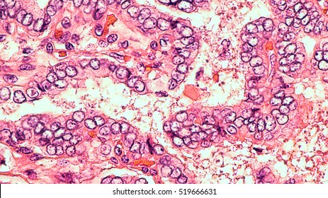 Thyroid Cancer Awareness (Microscopic): Papillary Thyroid Carcinoma Is Characterized By Branching Papillae With Fibrovascular Cores And Cells With Optically Clear Nuclei (