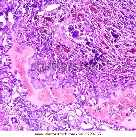 Thyroid cancer, Papillary thyroid microcarcinoma with nodular colloid goitre. Atypical thyroid follicular cells show nuclear clearing. Extensive fibrosis.