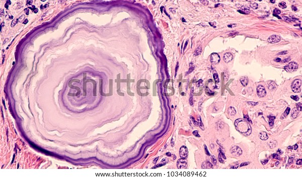 Thyroid Cancer Psammoma Bodies Granules Concentric Stock Photo (Edit ...