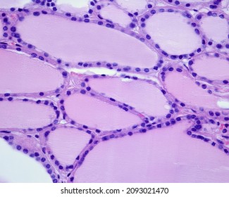 Thyroid follicles with an epithelium formed by flattened thyrocytes, cubic in shape. The colloid shows a homogeneous appearance and fills the entire follicular cavity.