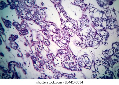 Thyroid Follicular Carcinoma, Light Micrograph, Photo Under Microscope