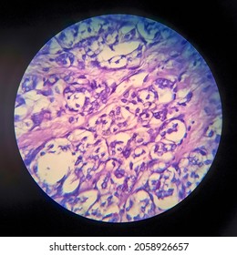 Thyroid Follicular Carcinoma, Light Micrograph, Photo Under Microscope