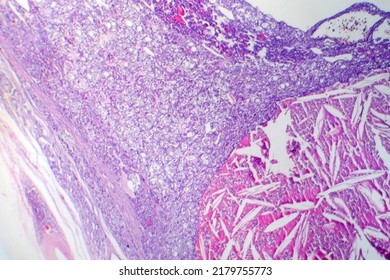 Thyroid Follicular Carcinoma, Light Micrograph, Photo Under Microscope