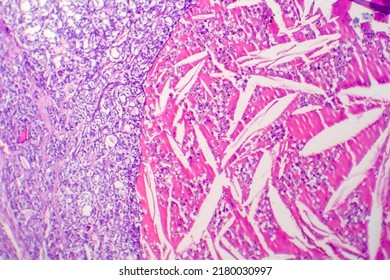 Thyroid Follicular Carcinoma, Light Micrograph, Photo Under Microscope