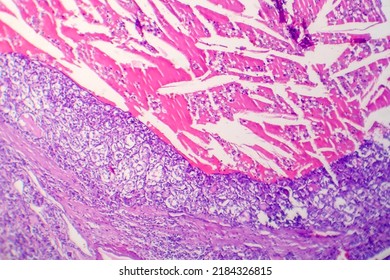 Thyroid Follicular Carcinoma, Light Micrograph, Photo Under Microscope