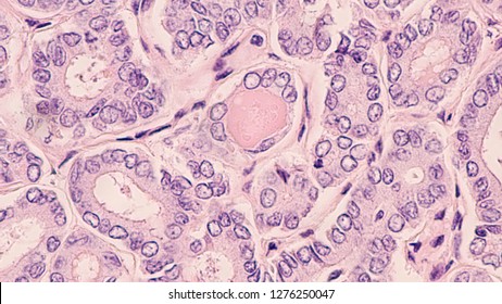 Thyroid Gland Cancer Awareness: Microscopic Image Of Papillary Thyroid Carcinoma, Follicular Variant, Showing Optically Clear (