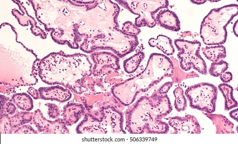 Thyroid gland cancer awareness: Microscopic image of papillary thyroid carcinoma, characterized by branching papillae with fibrovascular cores 