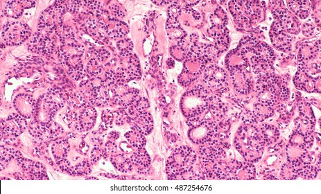 Thyroid Gland Nodule: Thyroid adenoma is a benign tumor composed of a proliferation of thyroid follicles, including a microfollicular pattern, without vascular or capsular invasion.