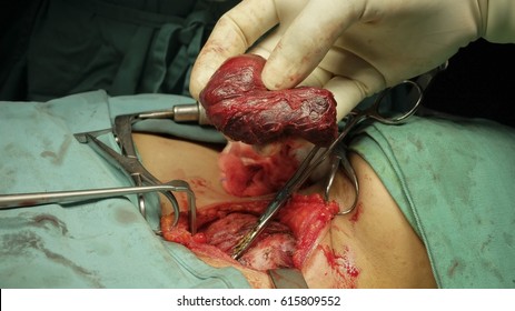 Thyroid Gland  Surgery