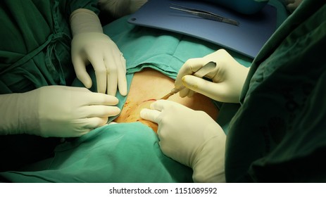 Thyroid Skin Incision In Throidectomy Surgery. Step By Step.