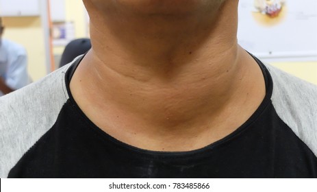 Thyroid Swelling or Goitre .