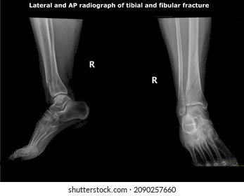 Tibia Comminuted fracture.Distal fibula and tibia fracture showed by radiograph,X-ray.

70 year old woman falling down a ladder. she will go under surgical operation.