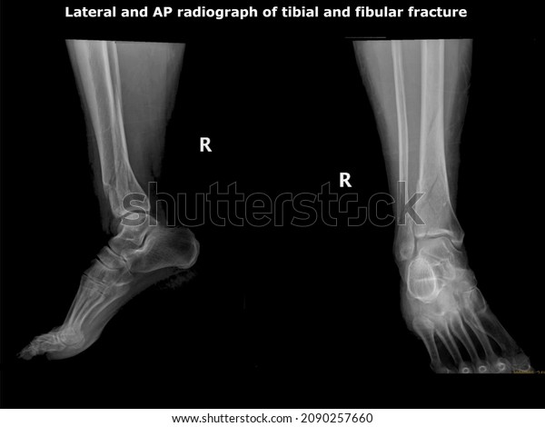Tibia Comminuted\
fracture.Distal fibula and tibia fracture showed by\
radiograph,X-ray.\
\
70 year old woman falling down a ladder. she\
will go under surgical\
operation.