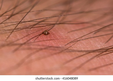 Tick Biting Man's Hairy Arm. A Tiny Nymph Sheep Tick (Ixodes Ricinus) Feeding On Blood Through Skin Of Person.