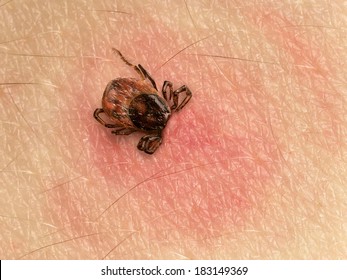 Marcado con la cabeza pegada en la piel humana, los manchas rojas indican una infección