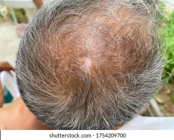 Tinea Capitis Or Fungal Infection On Scalp On Head Of Asian Old Man.