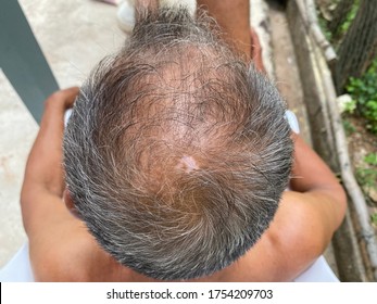 Tinea Capitis Or Fungal Infection On Scalp On Head Of Asian Old Man.