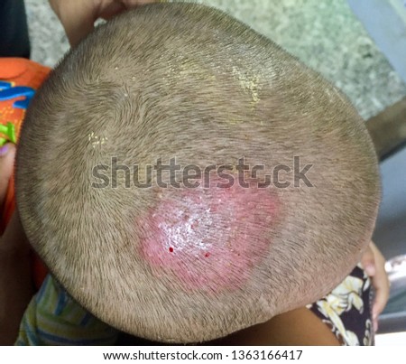 Tinea Capitis or Fungal Infection on Scalp of Southeast Asian, Burmese two years old  Child in Clinic