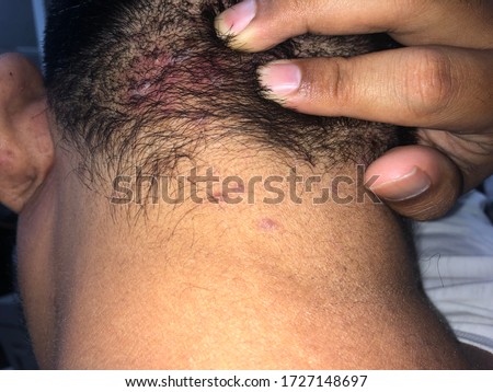 Tinea capitis. Redness on the head.