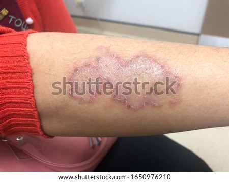 Tinea Corporis (Dermatophytosis, Superficial skin infection)