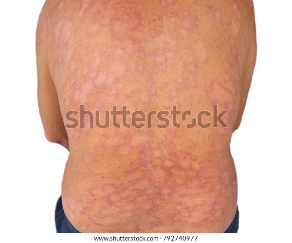 Tinea Corporis Fungal Infection Mycosis Stock Photo (Edit ...