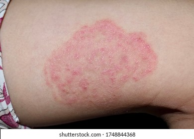 Tinea Corporis or Fungal Infection on thigh of Southeast Asian, Burmese little boy. It is a superficial dermatophyte infection. Isolated on black background. - Shutterstock ID 1748844368