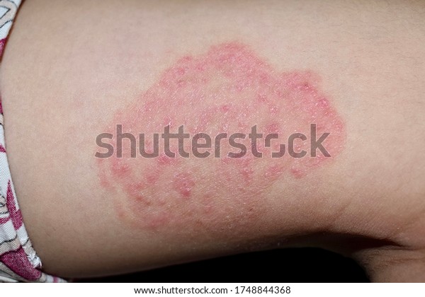 Tinea Corporis or Fungal Infection on\
thigh of Southeast Asian, Burmese little boy. It is a superficial\
dermatophyte infection. Isolated on black\
background.