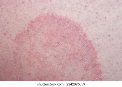 Tinea cruris, also known as jock itch, is a common type of contagious, superficial fungal infection of the groin region, which occurs predominantly but not exclusively in men and in hot-humid climates