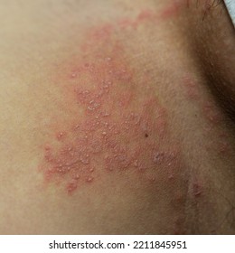 Tinea Cruris, Ring Worm Infection On Skin, Itching In The Groin