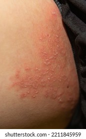 Tinea Cruris, Ring Worm Infection On Skin, Itching In The Groin