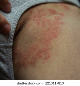 Tinea Cruris, Ring Worm Infection On Skin, Itching In The Groin