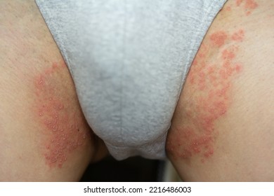 Tinea Cruris, Ring Worm Infection On Skin, Itching In The Groin