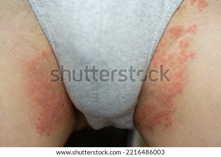 Tinea Cruris, Ring Worm infection on skin, Itching in the groin