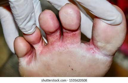 Tinea Pedis or or Athlete's foot or Fungal Infection between big toe and second toe of Southeast Asian, Burmese woman. It is superficial dermatophyte infection limited to glabrous skin of leg.