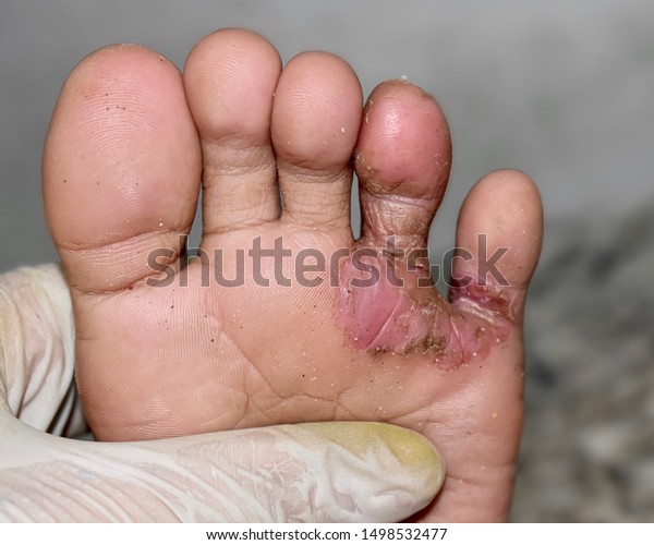 Tinea Pedis Athletes Foot Fungal Infection 庫存照片 立刻編輯 1498532477