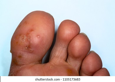 Tinea Pedis, Fungal Infection. Athlete's Foot .