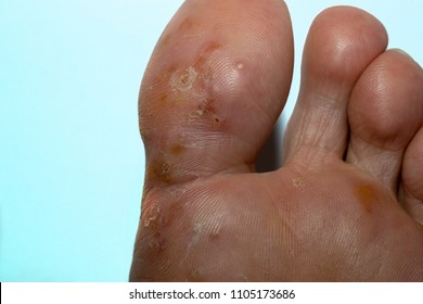 Tinea Pedis, Fungal Infection. Athlete's Foot .