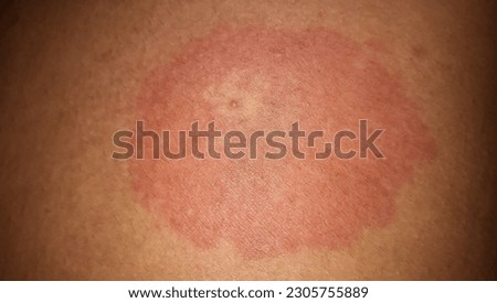 Tinea pedis ( ringworm  infection )  of the Body  Back. Tinea corporis or Dermatophytosis  on skin .