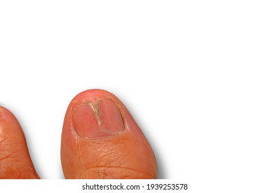 Tinea Unguium Hd Stock Images Shutterstock