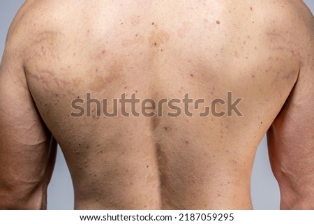 tinea versicolor on the male back. pityriasis versicolor problem with skin. acne skin back. scoliosis