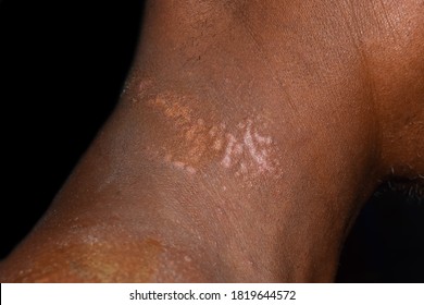 Tinea versicolor or pityriasis alba in neck of Southeast Asian man. Isolated on black.