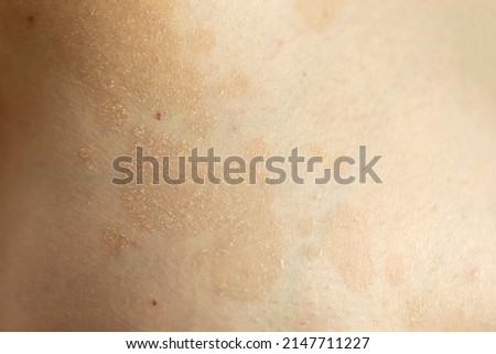 Tinea versicolor (pityriasis versicolor), a fungal or yeast skin rash caused by too much growth of yeast, causing discoloration and patches. Skin problem, dermatology concept