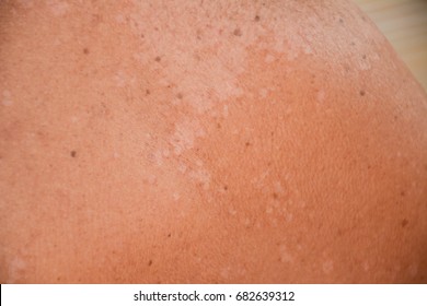 Tinea Versicolor Bilder Stockfotos Und Vektorgrafiken Shutterstock