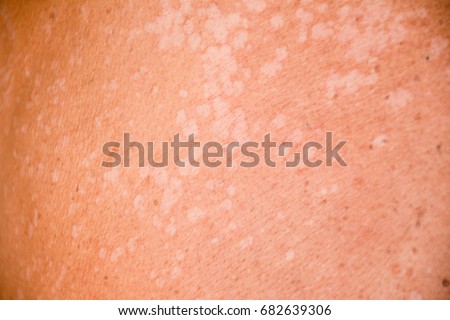 Tinea versicolor/Pityriasis versicolor on the skin