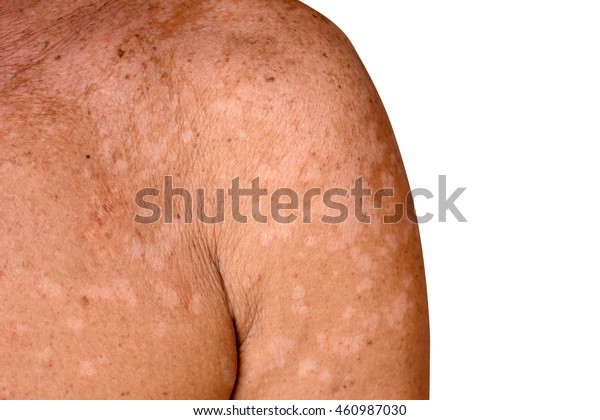 Suchen Sie Nach Tinea Versicolor Pityriasis Versicolor Auf Der Haut Stockbildern In Hd Und Millionen Weiteren Lizenzfreien Stockfotos Illustrationen Und Vektorgrafiken In Der Shutterstock Kollektion Jeden Tag Werden Tausende Neue Hochwertige Bilder