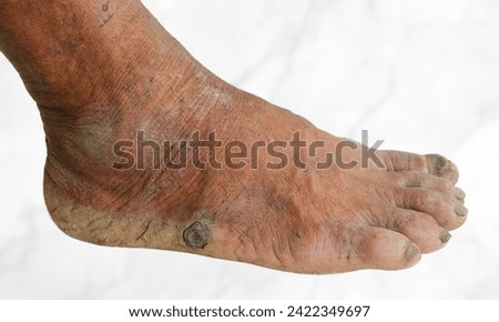 Tingling and burning sensation in foot of Asian young man with diabetes. Foot pain. Sensory neuropathy problems. Foot nerves problems. Plantar fasciitis. Stock photo © 