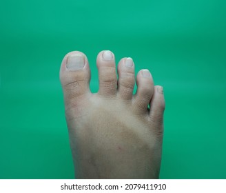 The Tip Of The Right Toe With Long Nails, And The Surface Of The Foot That Looks Sunburned.