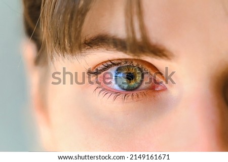 Tired eyes and contact lenses. Close up. Green eyes of a teenager inflamed and with red veins Stockfoto © 