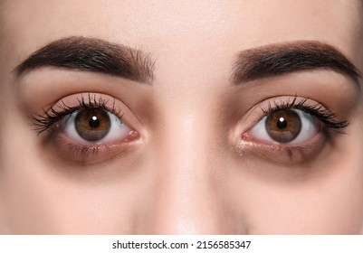 Tired Young Woman With Dark Circles Under Eyes, Closeup