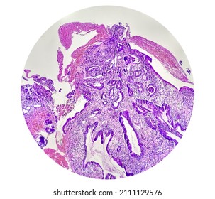 Tissue From Gastro-jejunostomy Stomal Site ( Endoscopic Biopsy) Hematoxylin And Eosin Stained Microscopic 40x Show Chronic Chronic Nonspecific Gastritis With Mild Dysplasia.